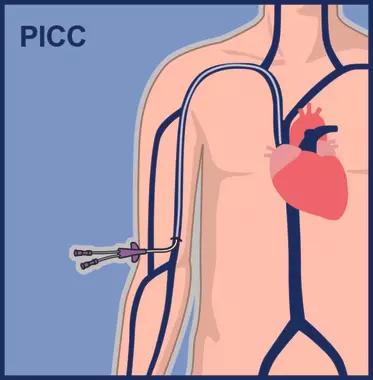 Picc line image